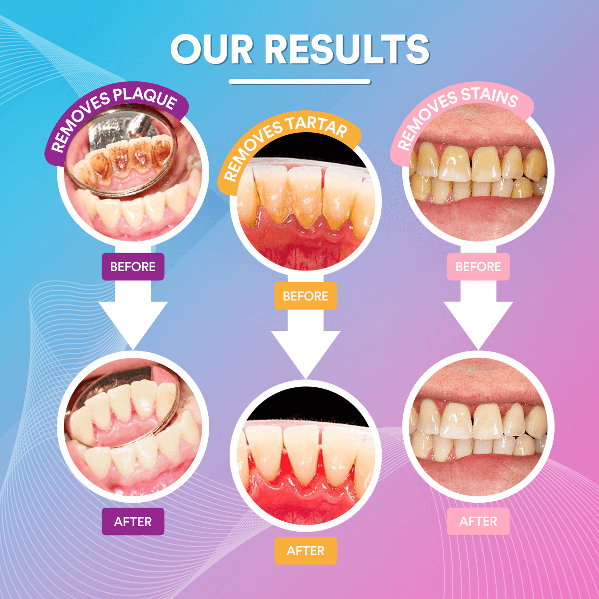 Ultrasonic Tooth Cleaner Results