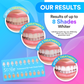 PAP+ Teeth Whitening Kit - With 6 Treatments